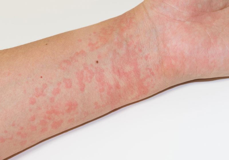 蕁麻疹