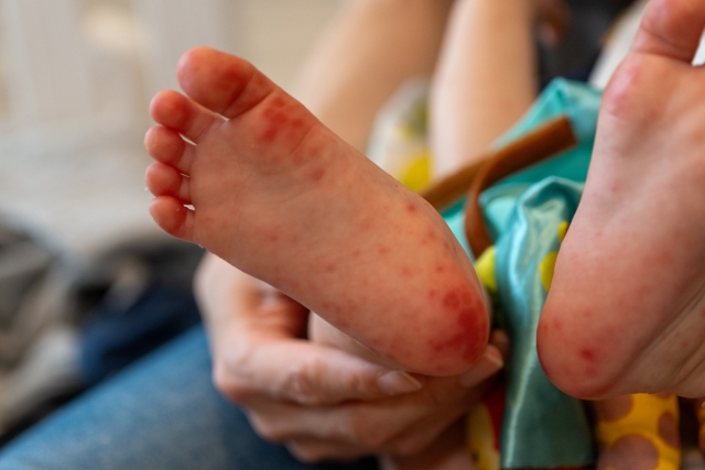 手足口病にかかった子供の足の裏