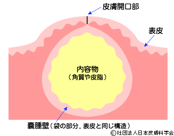 粉瘤とは